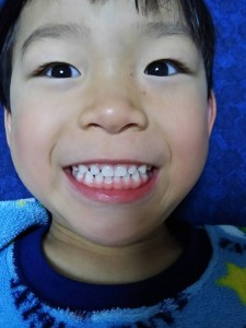 乳歯の生え変わり2